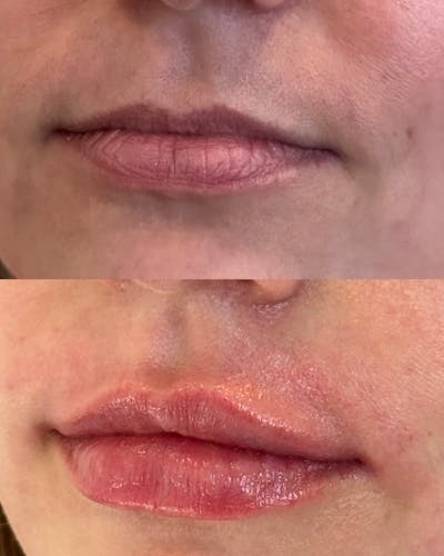 Lip Filler Before & After Gallery - Patient 195521 - Image 1