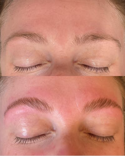 Brows Before & After Gallery - Patient 814677 - Image 1