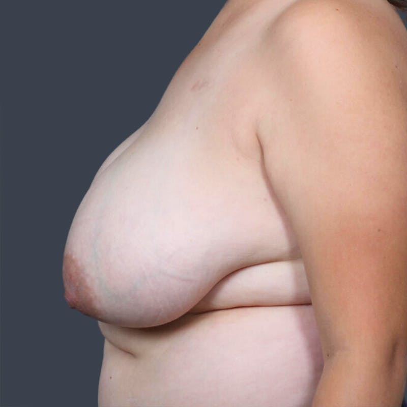 Breast Reduction Before & After Gallery - Patient 112845 - Image 5