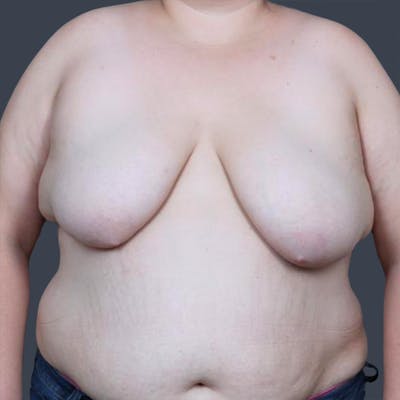 Breast Reduction Before & After Gallery - Patient 300882 - Image 1