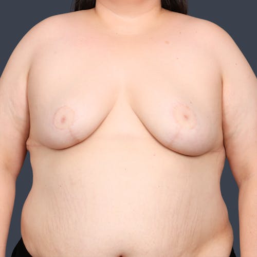After procedure image for Breast Reduction