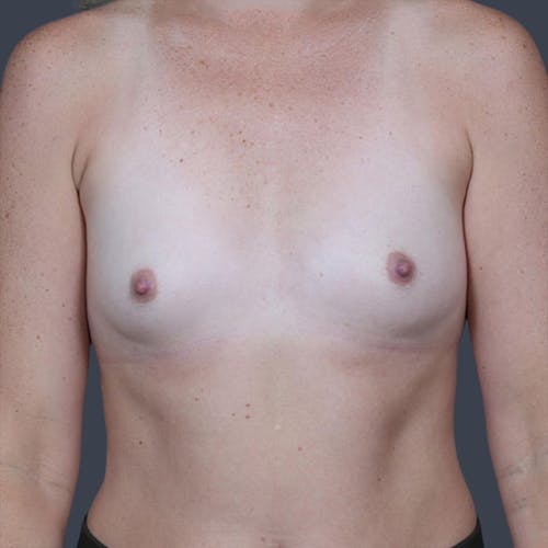Before procedure image for Breast Augmentation