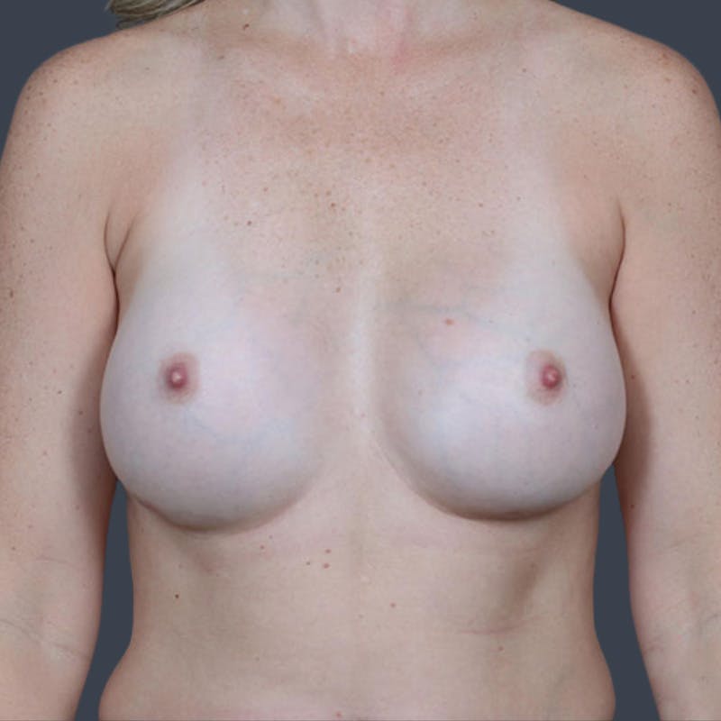Breast Augmentation Before & After Gallery - Patient 405401 - Image 2