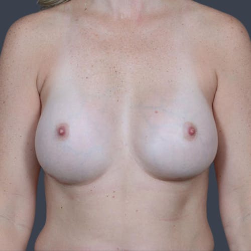 After procedure image for Breast Augmentation