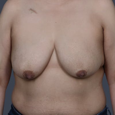 Oncoplastic Breast Reconstruction Before & After Gallery - Patient 298326 - Image 1