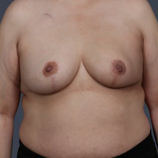 Oncoplastic/Lumpectomy Reconstruction Before & After Gallery - Patient 298326 - Image 2