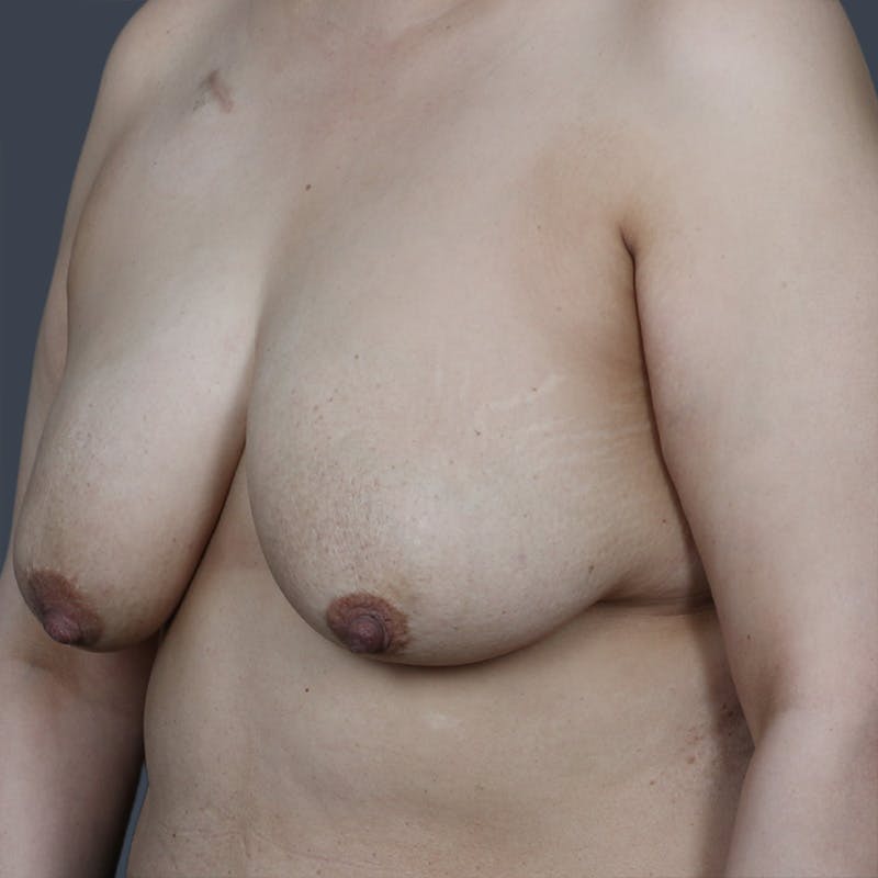 Oncoplastic Breast Reconstruction Before & After Gallery - Patient 298326 - Image 3