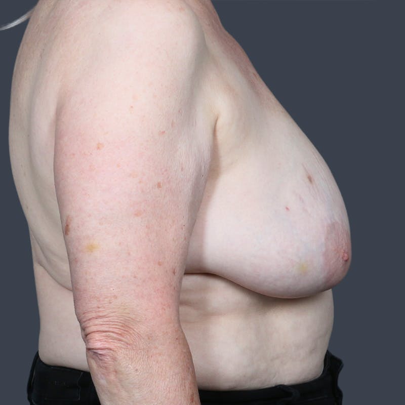 Oncoplastic Breast Reconstruction Before & After Gallery - Patient 351473 - Image 3