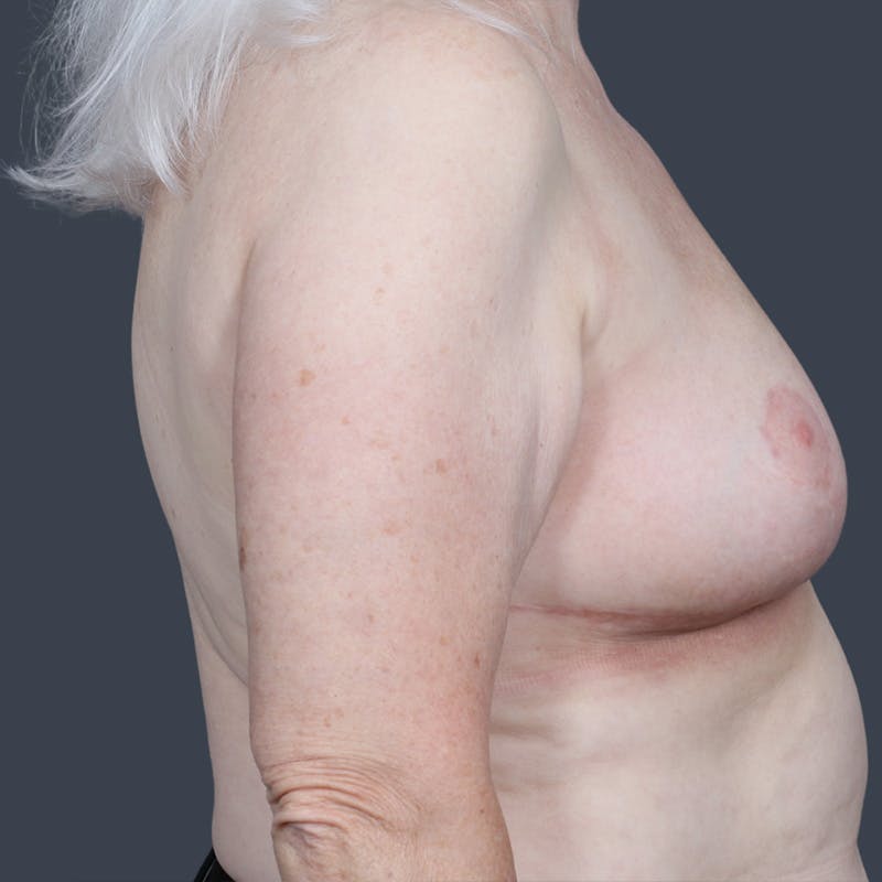 Oncoplastic Breast Reconstruction Before & After Gallery - Patient 351473 - Image 4