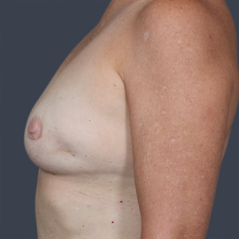 Oncoplastic Breast Reconstruction Before & After Gallery - Patient 686807 - Image 3