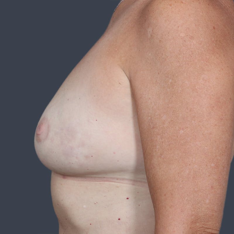 Oncoplastic Breast Reconstruction Before & After Gallery - Patient 686807 - Image 4