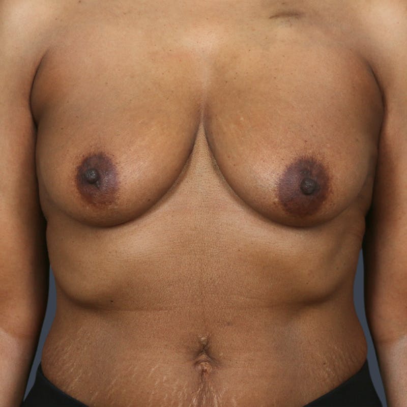 Oncoplastic Breast Reconstruction Before & After Gallery - Patient 247721 - Image 1