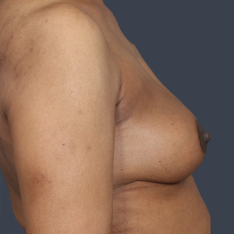 Oncoplastic Breast Reconstruction Before & After Gallery - Patient 247721 - Image 4