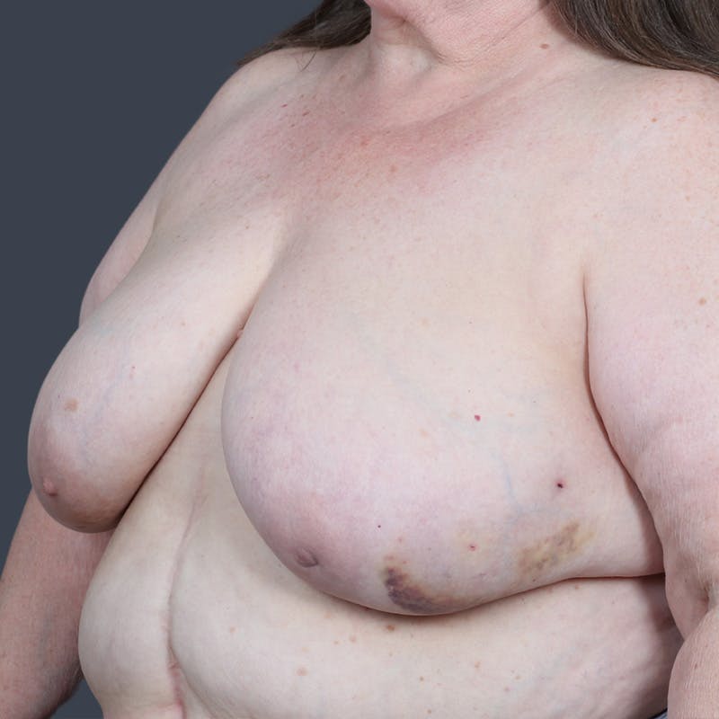 Oncoplastic Breast Reconstruction Before & After Gallery - Patient 343822 - Image 3