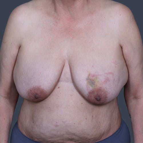 Before procedure image for Oncoplastic Breast Reconstruction