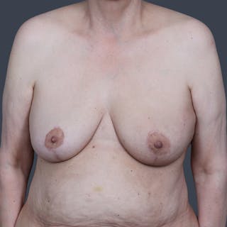 Oncoplastic/Lumpectomy Reconstruction Before & After Gallery - Patient 232884 - Image 2