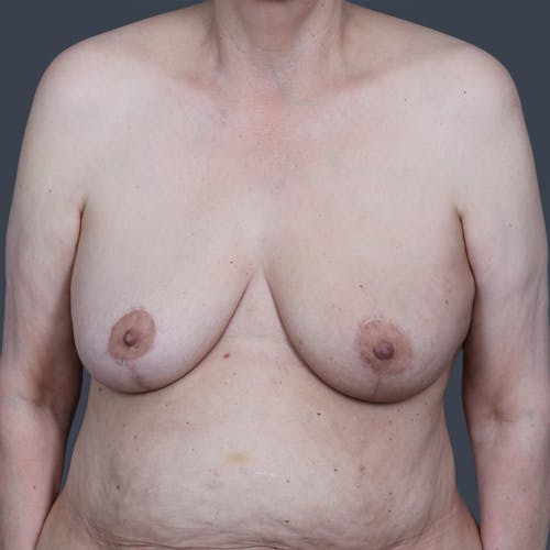 After procedure image for Oncoplastic Breast Reconstruction