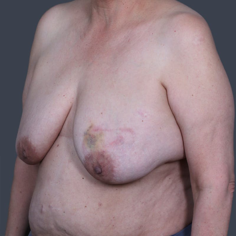 Oncoplastic Breast Reconstruction Before & After Gallery - Patient 232884 - Image 3