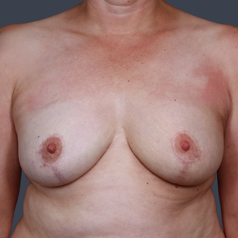 Oncoplastic Breast Reconstruction Before & After Gallery - Patient 427359 - Image 2