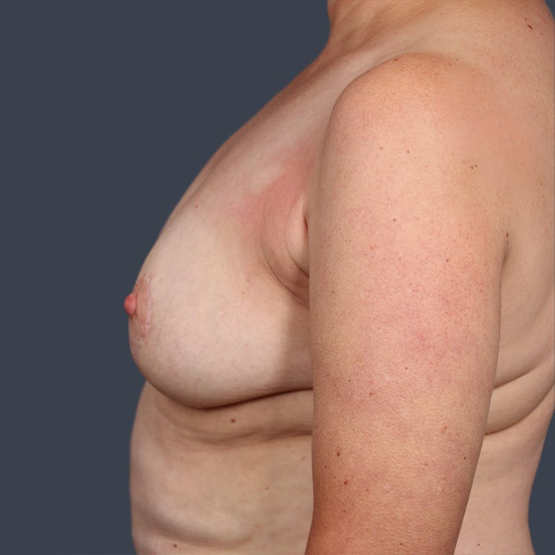 Oncoplastic Breast Reconstruction Before & After Gallery - Patient 427359 - Image 4