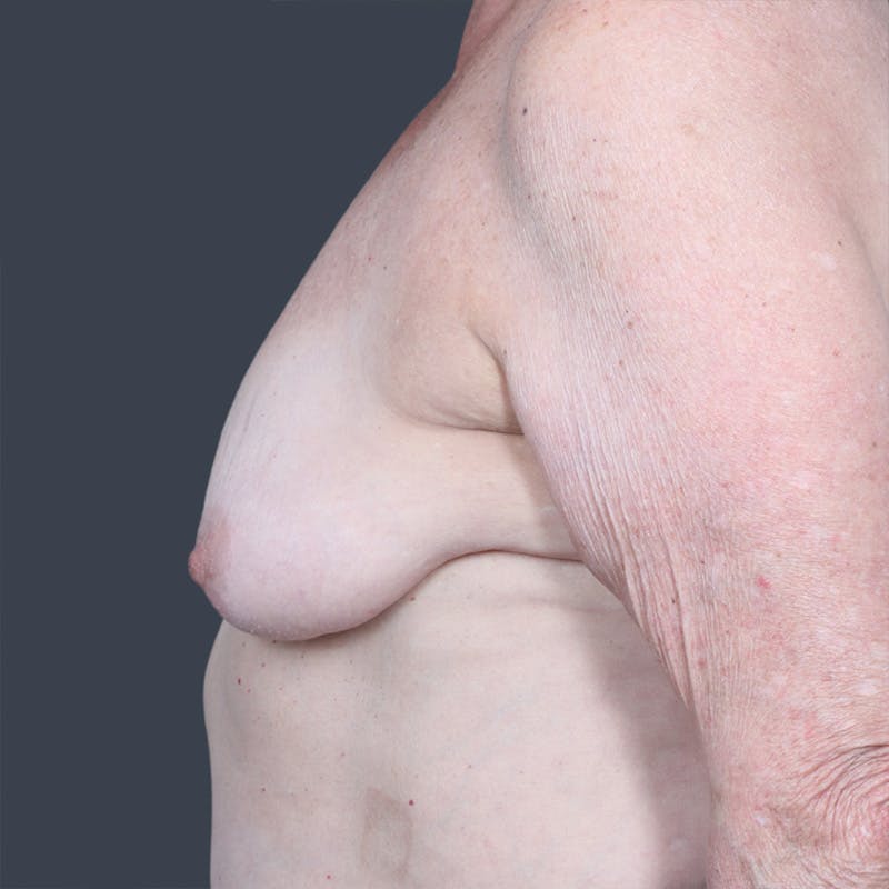 Oncoplastic Breast Reconstruction Before & After Gallery - Patient 315787 - Image 3