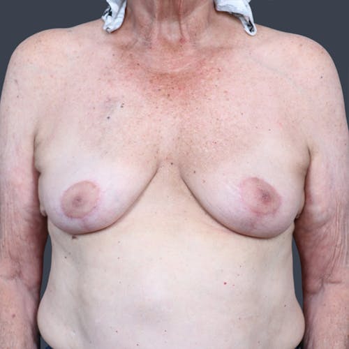 After procedure image for Oncoplastic Breast Reconstruction