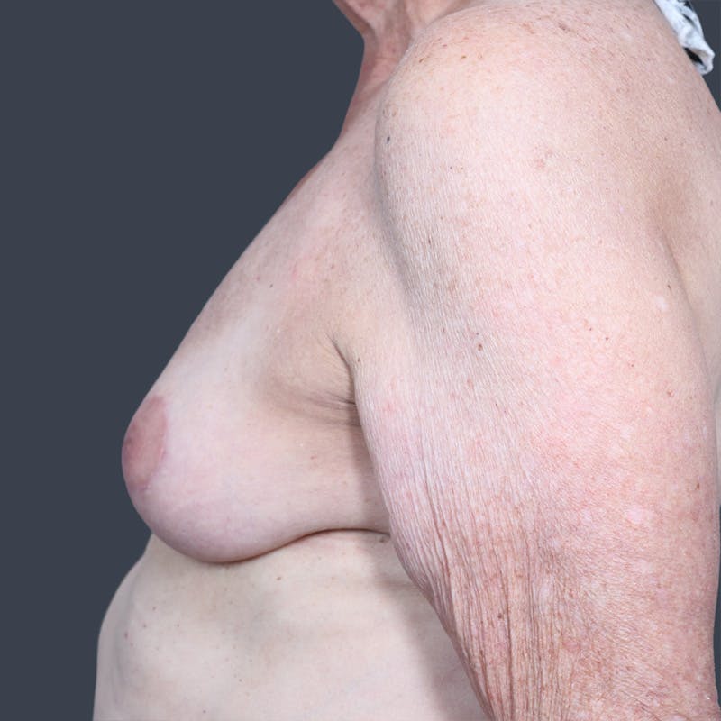 Oncoplastic Breast Reconstruction Before & After Gallery - Patient 315787 - Image 4