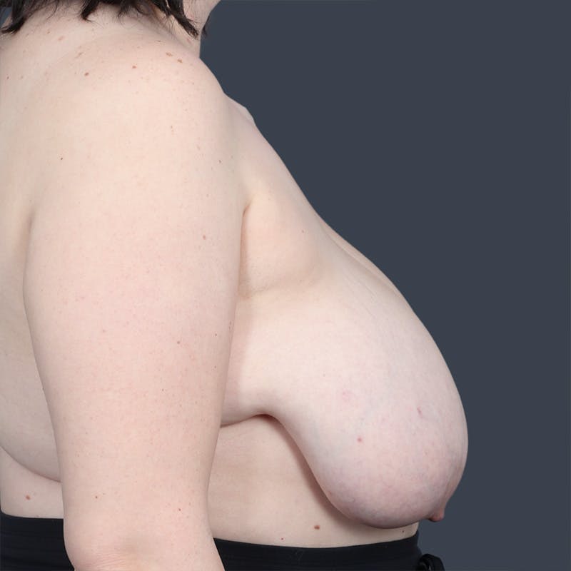 Oncoplastic Breast Reconstruction Before & After Gallery - Patient 773715 - Image 3