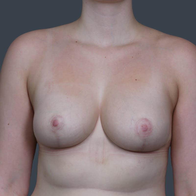 Breast Reduction Before & After Gallery - Patient 231313 - Image 2