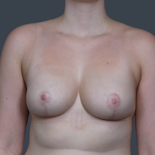After procedure image for Breast Reduction