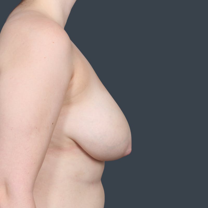 Breast Reduction Before & After Gallery - Patient 231313 - Image 5