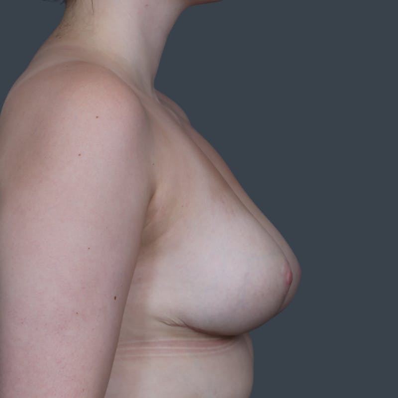 Breast Reduction Before & After Gallery - Patient 231313 - Image 6