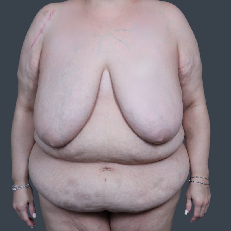 Breast Reduction Before & After Gallery - Patient 324919 - Image 1