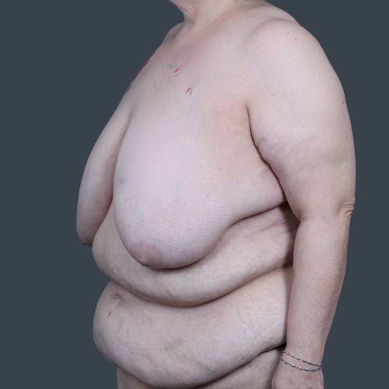 Breast Reduction Before & After Gallery - Patient 324919 - Image 5