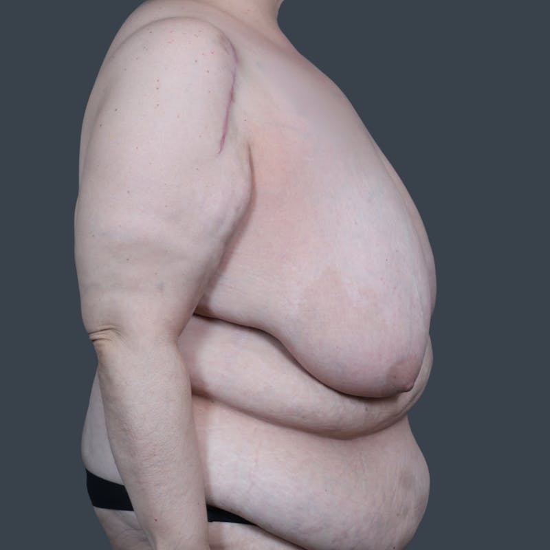 Breast Reduction Before & After Gallery - Patient 324919 - Image 3