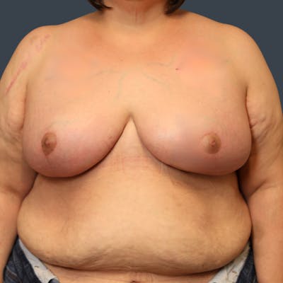 Breast Reduction Before & After Gallery - Patient 324919 - Image 2
