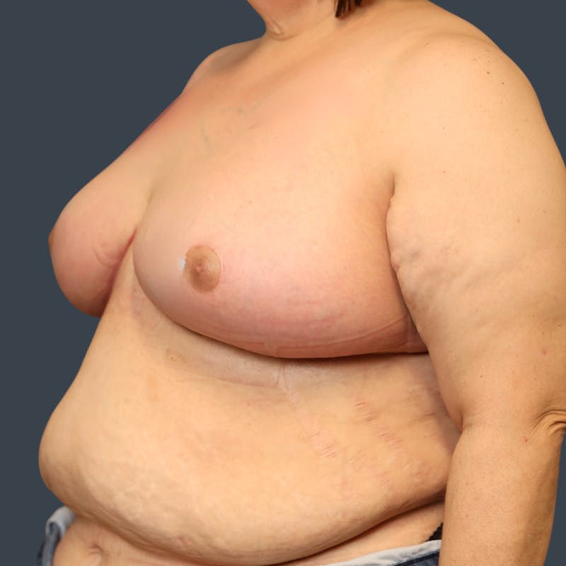 Breast Reduction Before & After Gallery - Patient 324919 - Image 6