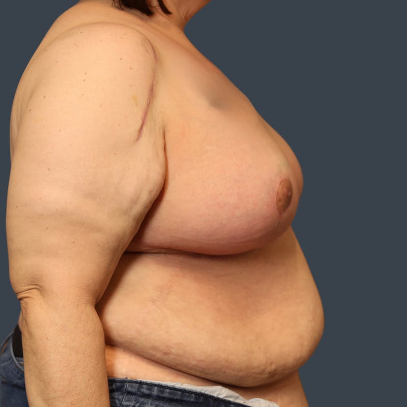 Breast Reduction Before & After Gallery - Patient 324919 - Image 4