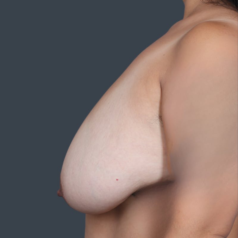 Breast Reduction Before & After Gallery - Patient 265360 - Image 3