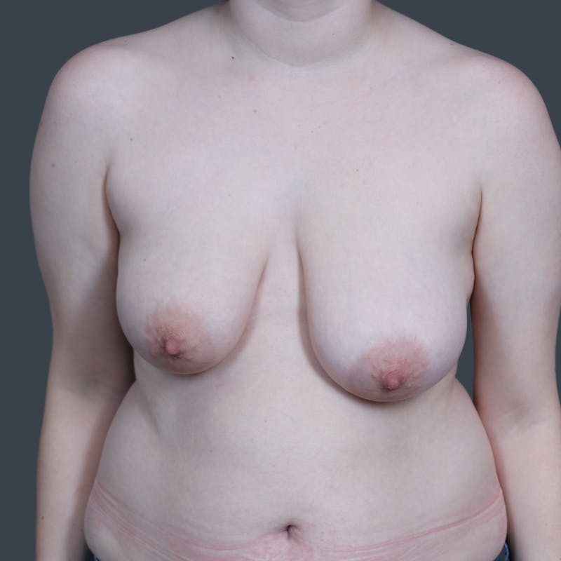 Breast Reduction Before & After Gallery - Patient 165555 - Image 1