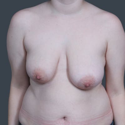 Breast Reduction Before & After Gallery - Patient 165555 - Image 1