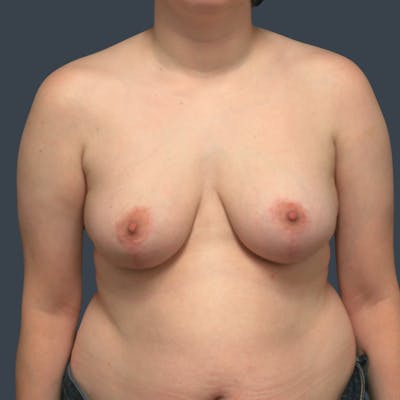 Breast Reduction Before & After Gallery - Patient 165555 - Image 2