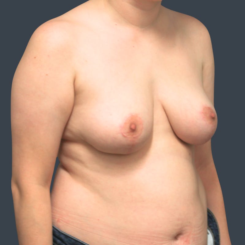 Breast Reduction Before & After Gallery - Patient 165555 - Image 4