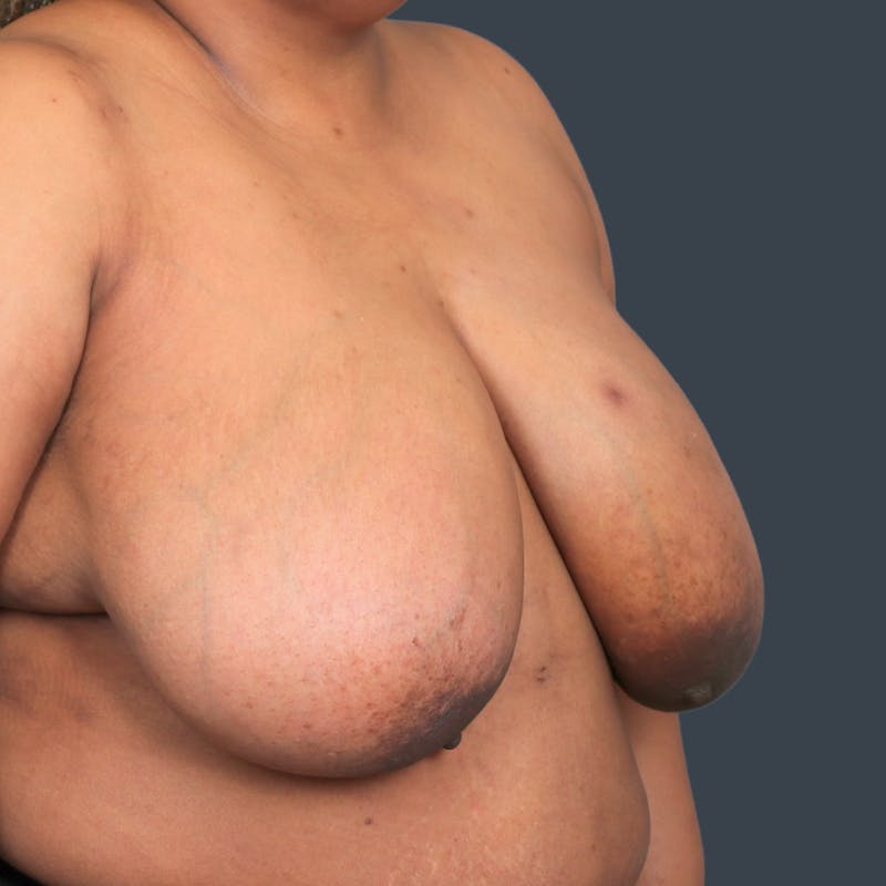 Breast Reduction Before & After Gallery - Patient 313825 - Image 3