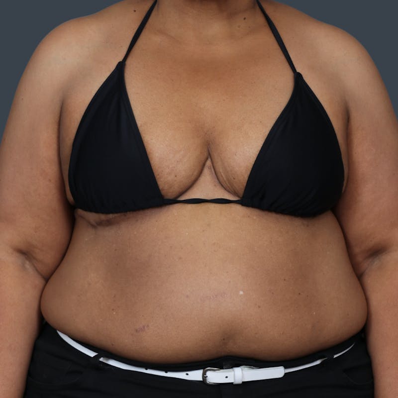 Breast Reduction Before & After Gallery - Patient 426849 - Image 2