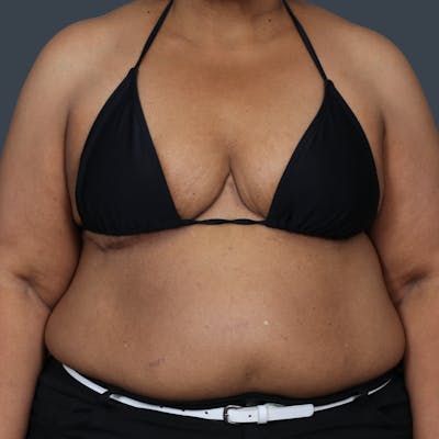 Breast Reduction Before & After Gallery - Patient 426849 - Image 2
