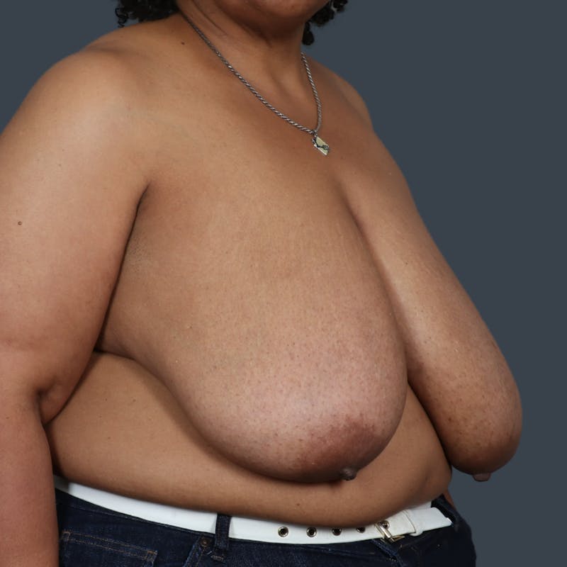 Breast Reduction Before & After Gallery - Patient 426849 - Image 3