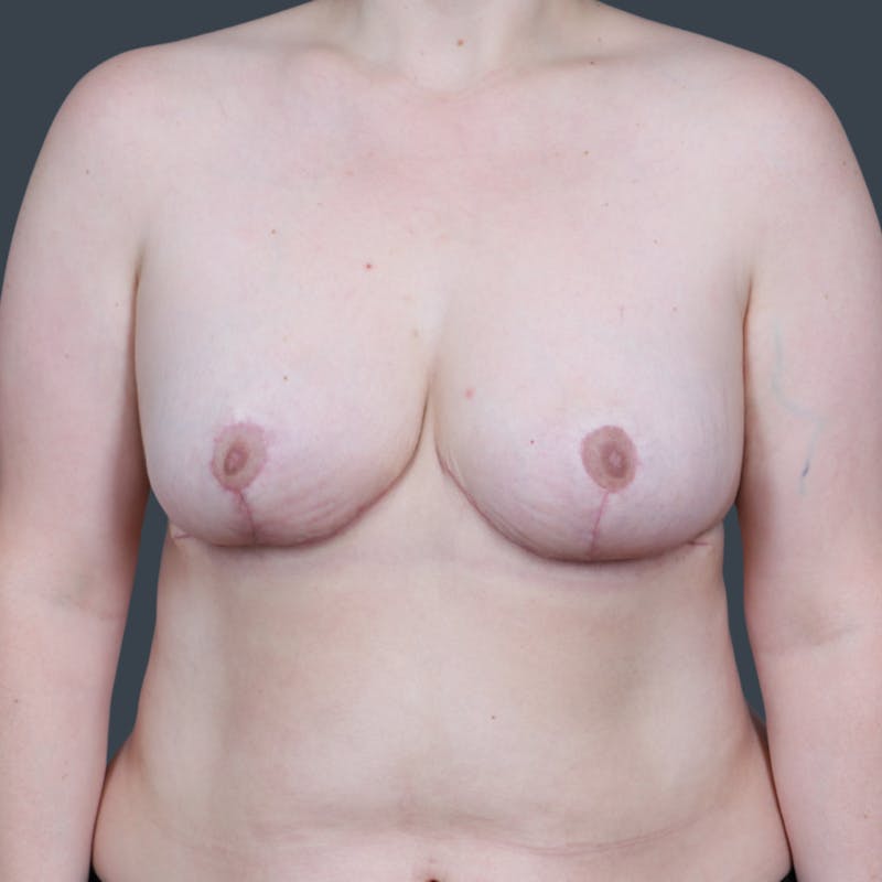 Breast Reduction Before & After Gallery - Patient 330636 - Image 2
