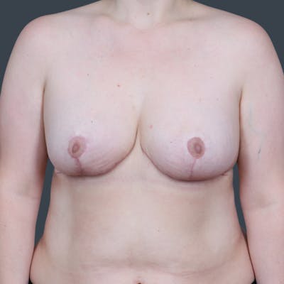 Breast Reduction Before & After Gallery - Patient 330636 - Image 2