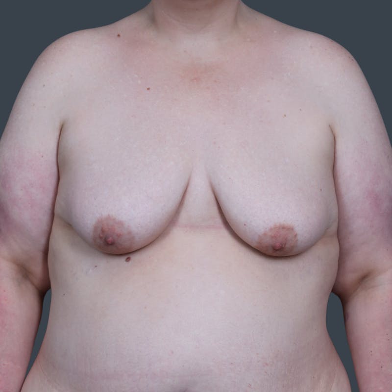 Breast Reduction Before & After Gallery - Patient 568847 - Image 1